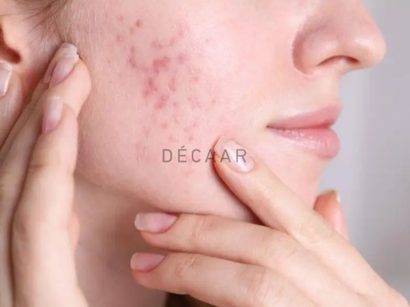 Mặt đột nhiên nổi nhiều mụn